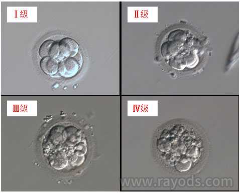浙江哪里代生好，试管婴儿取卵手术后的胚胎怎么评级？ABCD您的属于哪个级别